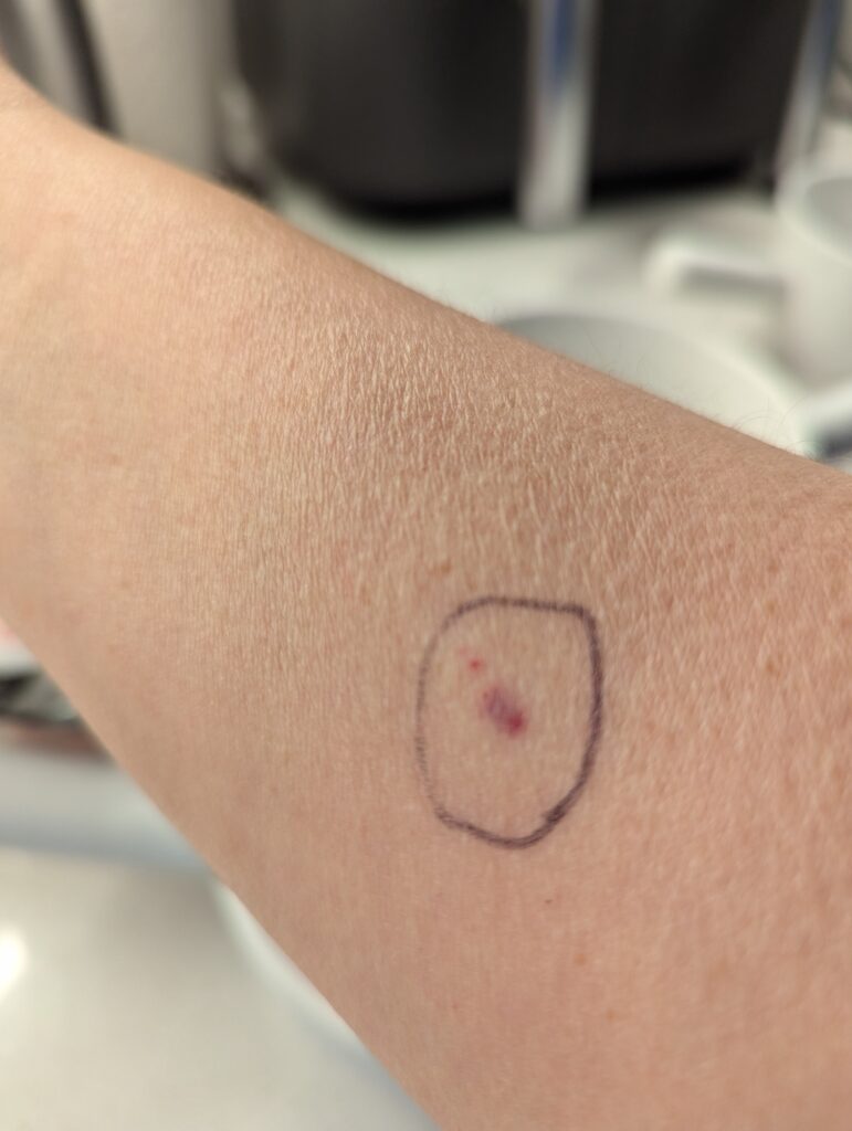 My forearm has a small red mark outlined by a ballpoint pen circle. 